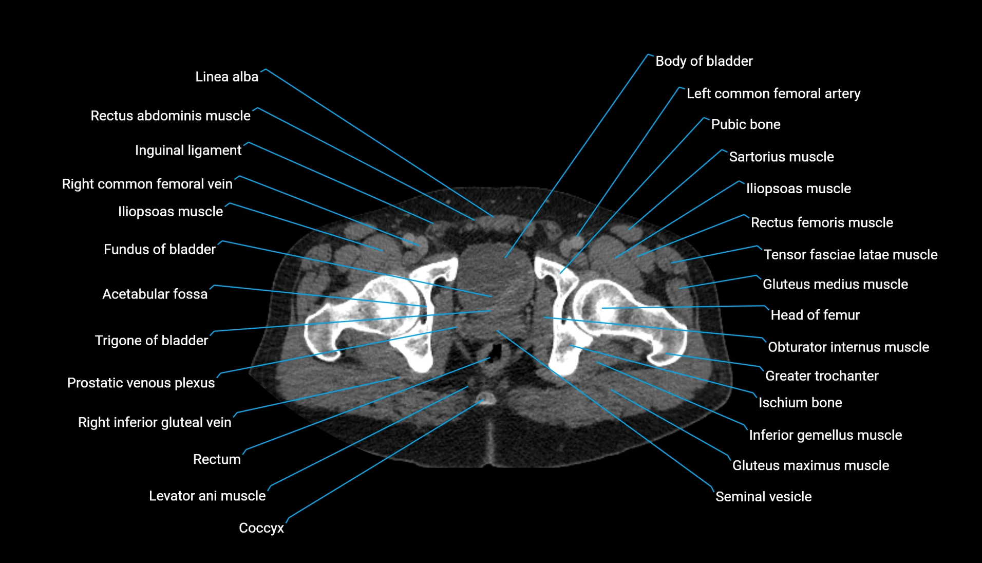 CT urogram axial cross sectional anatomy  labelled radiology image-00241.webp